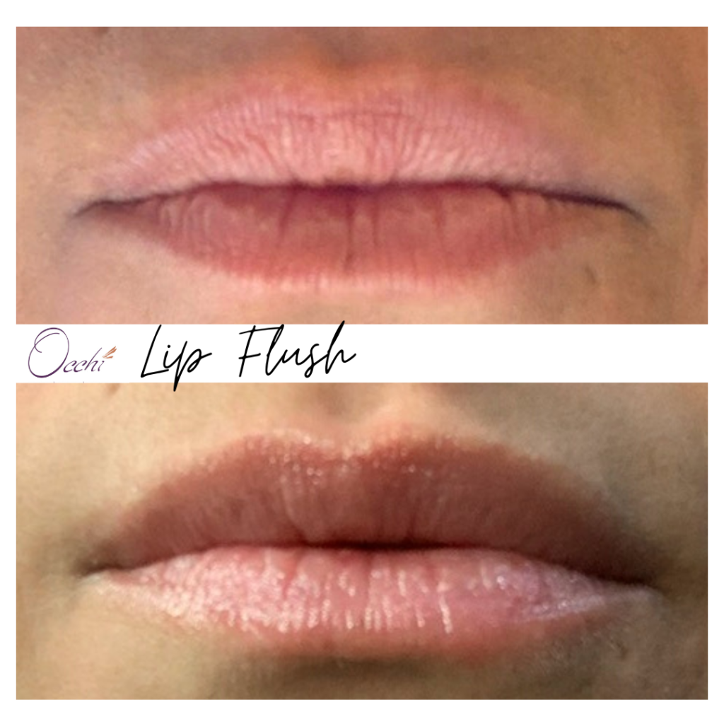 before and after image of lip