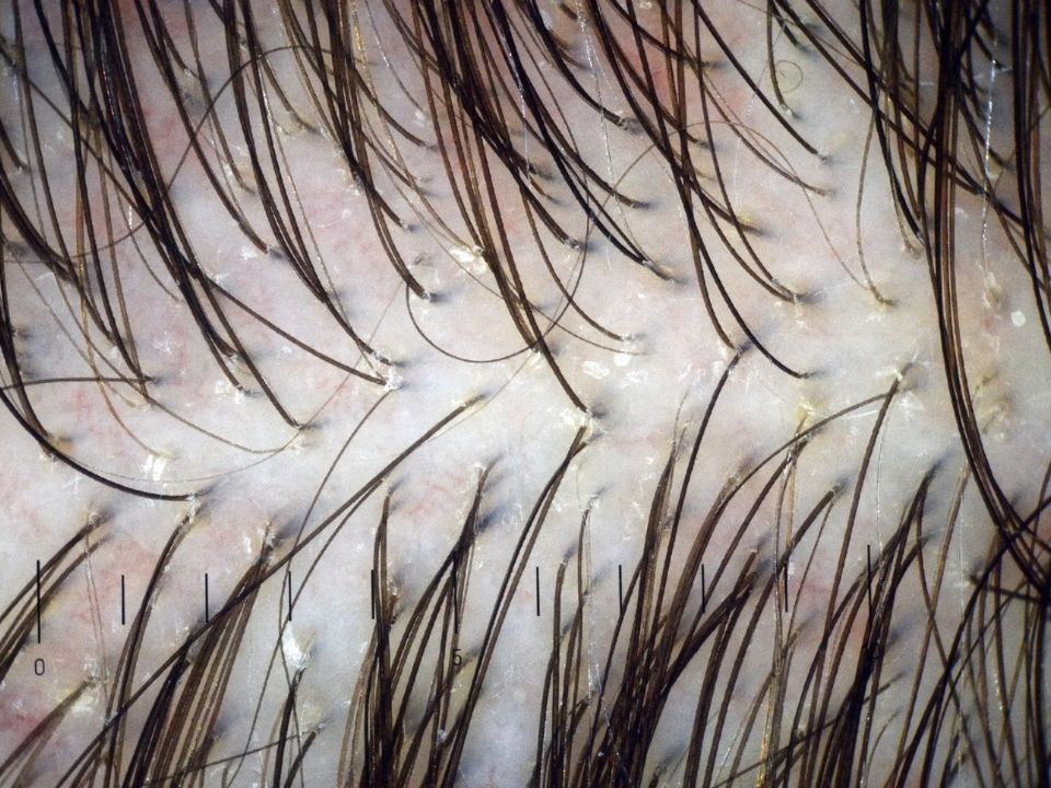 Scalp Issue | Oakbrook Terrace, IL | Occhi Lash & Brow Studio